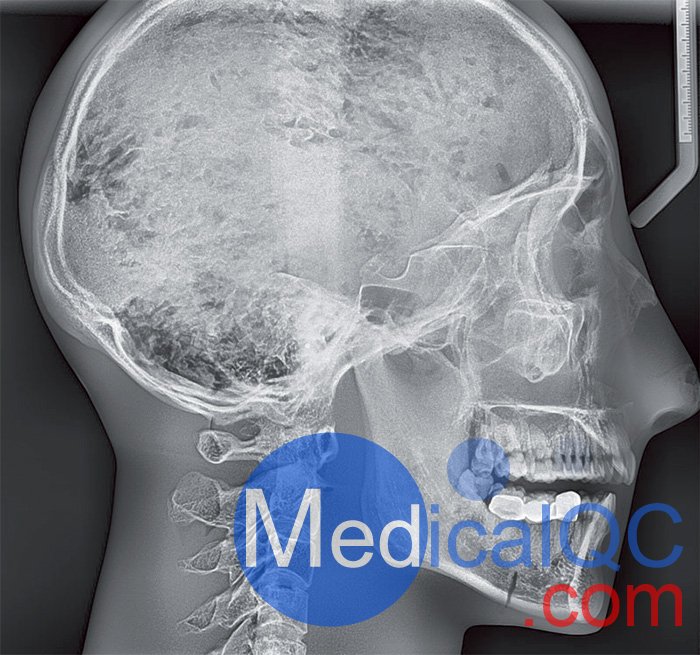 Erler Zimmer天然骨骼模體，Erler Zimmer頭部模體效果