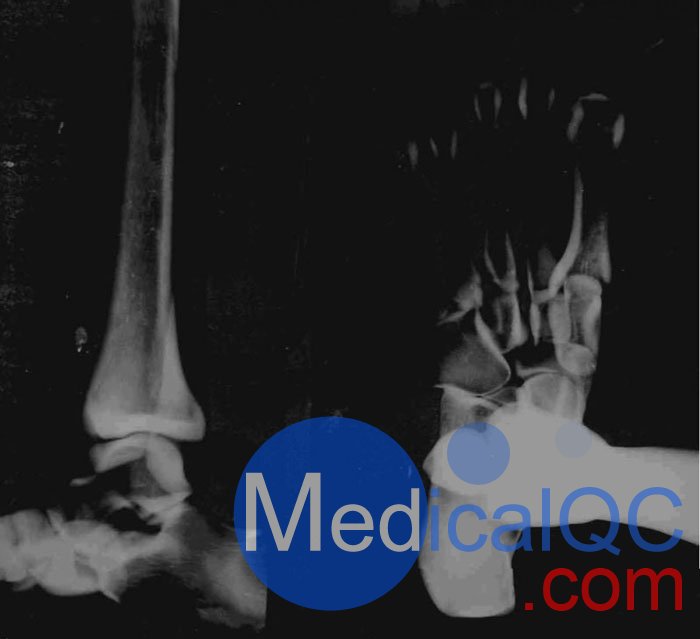 美國RSD RS-116腳模體，RS-116T透明腳模體